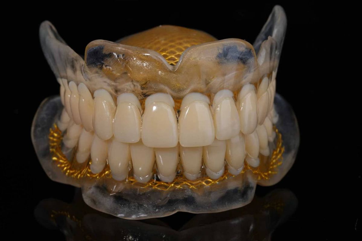 Upper and lower full dentures with gold mesh reinforcement