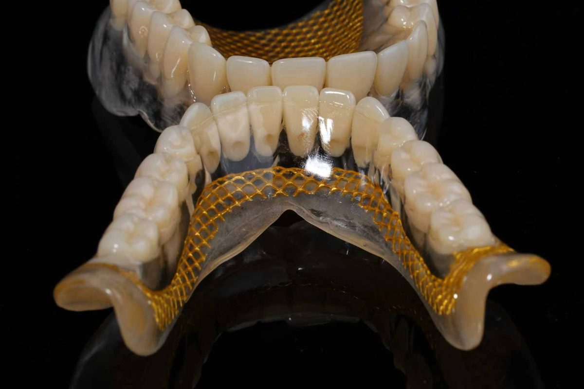 Mesh-reinforced full dentures, upper and lower pair