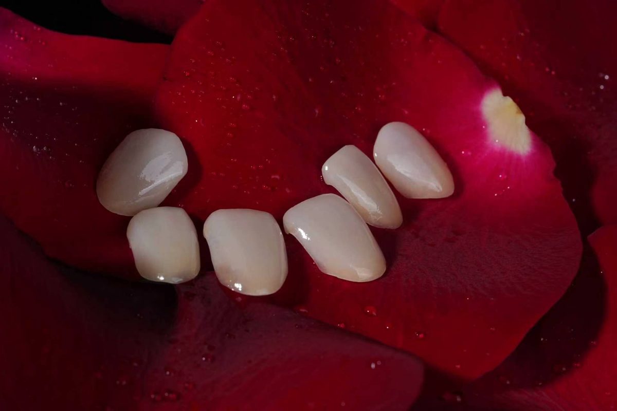 E.max veneers arranged on rose petals