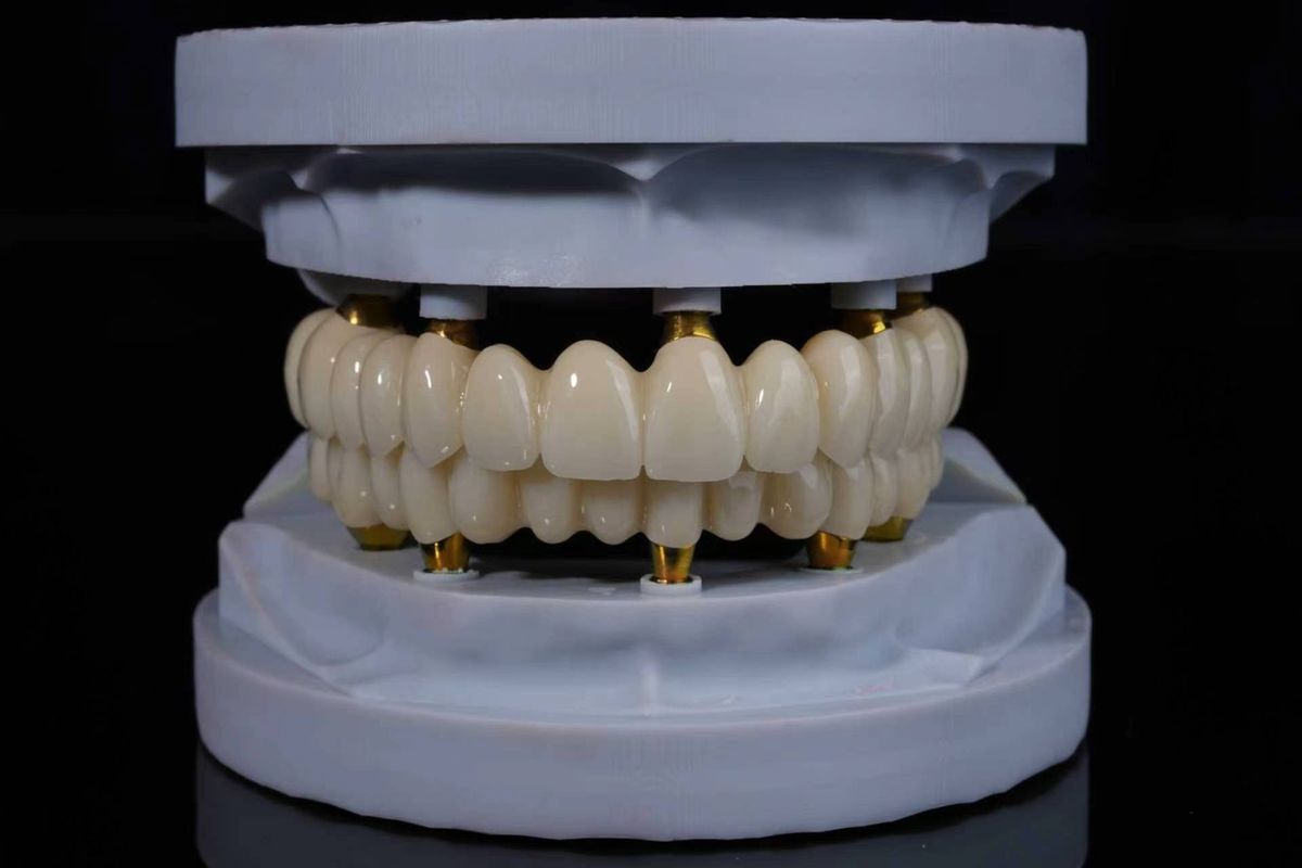 Implant-supported full arch with gold abutments